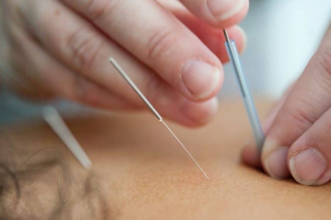 Acupuncture Benefits Stroke Patients
